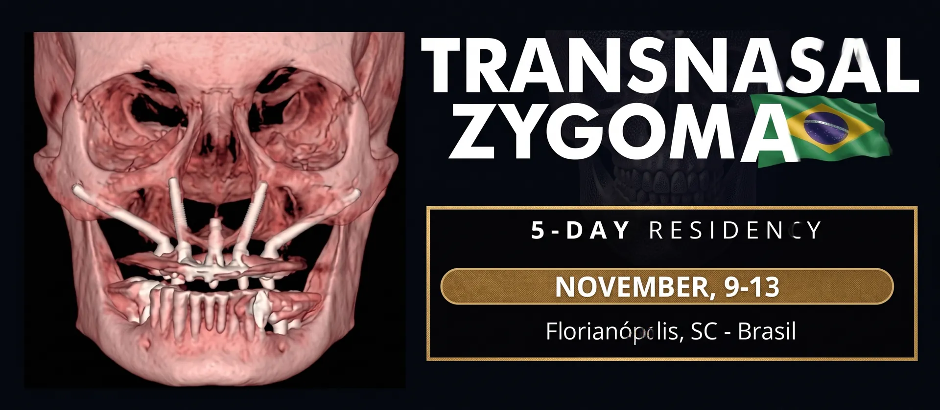 Curso Transnasal Zygoma - Inscrições Abertas