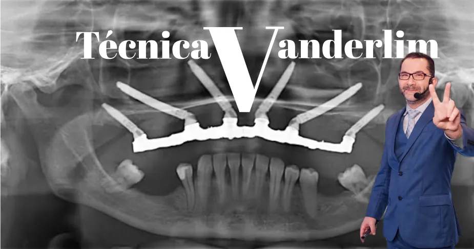 Técnica Vanderlim - Implantes Transnasais e Zigomáticos